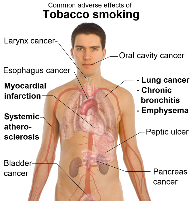 E Cigarette Popcorn Lung